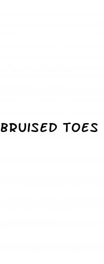 bruised toes diabetes