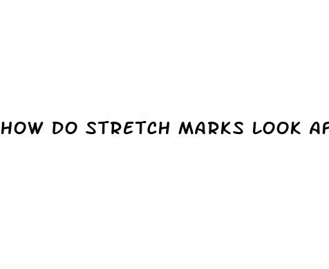 how do stretch marks look after weight loss