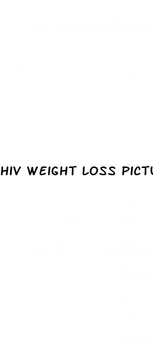 hiv weight loss pictures