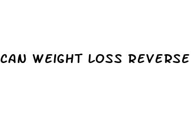 can weight loss reverse prediabetes