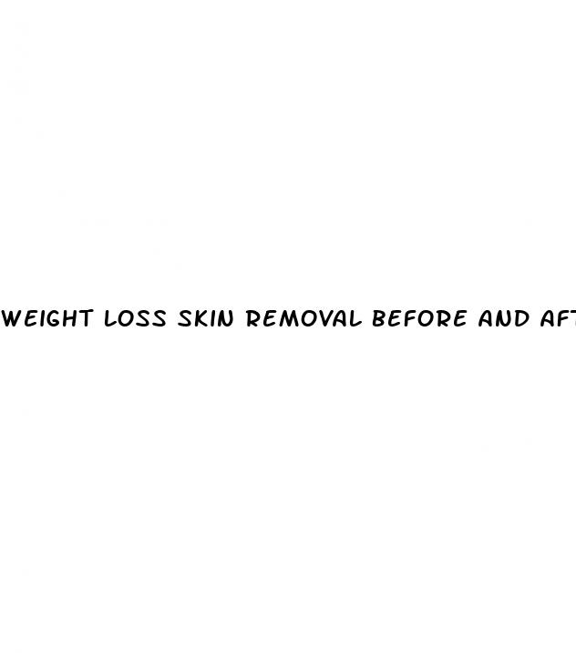 weight loss skin removal before and after