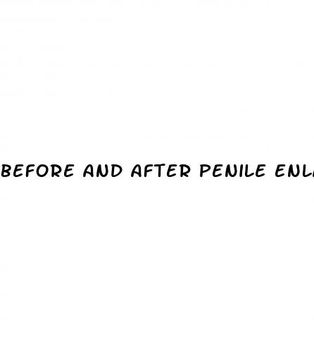 before and after penile enlargement surgery