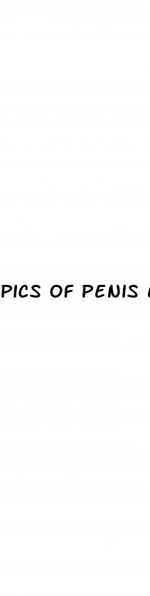 pics of penis enlargement