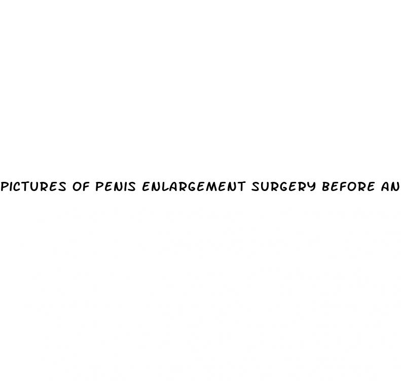 pictures of penis enlargement surgery before and after