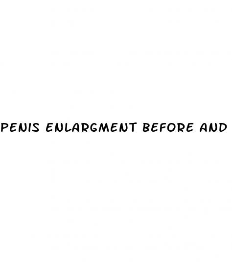 penis enlargment before and after with filler