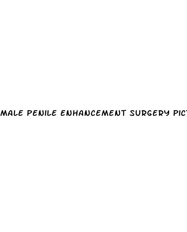 male penile enhancement surgery pictures