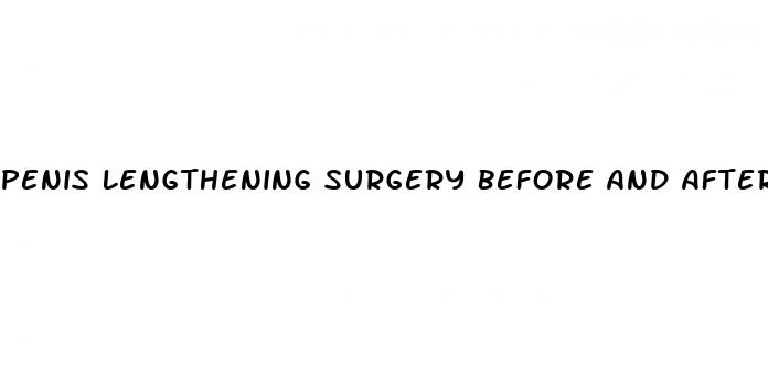 penis lengthening surgery before and after