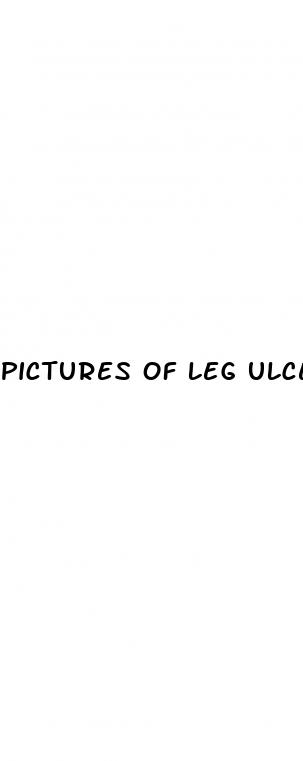 pictures of leg ulcers with diabetes