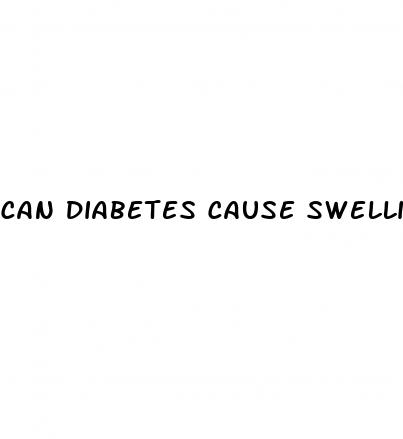 can diabetes cause swelling in the legs