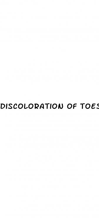 discoloration of toes in diabetes