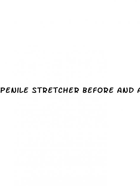penile stretcher before and after