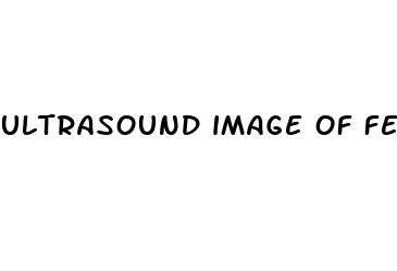 ultrasound image of fetus penis erection