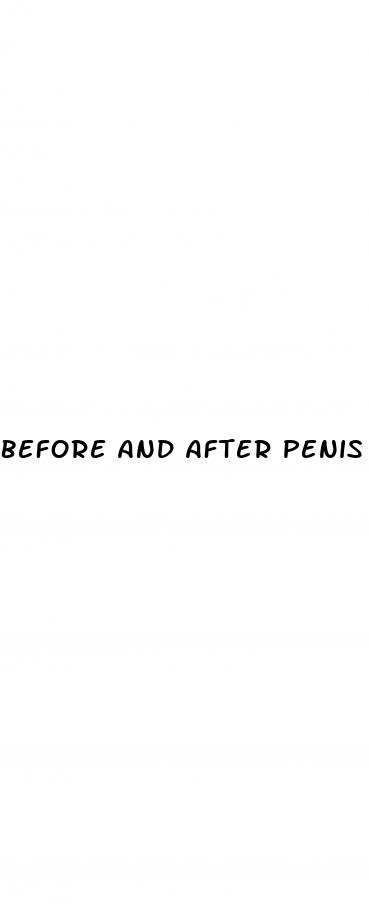 before and after penis enlargement surgery surgery life enhancement