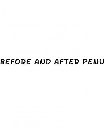 before and after penuma