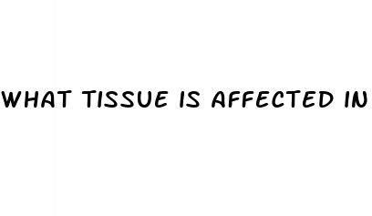 what tissue is affected in hypertension
