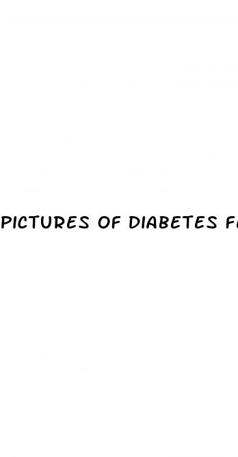 pictures of diabetes feet