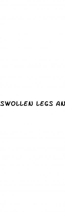 swollen legs and feet diabetes
